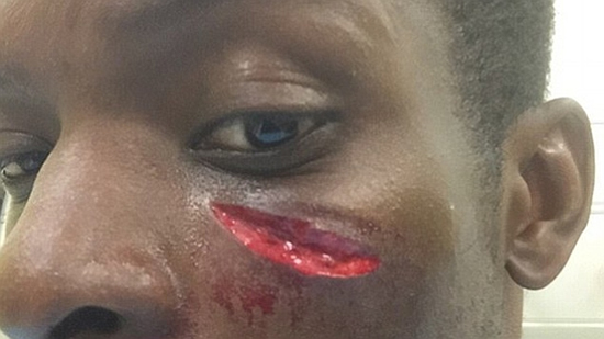 Onuoha left with nasty cut by teammate