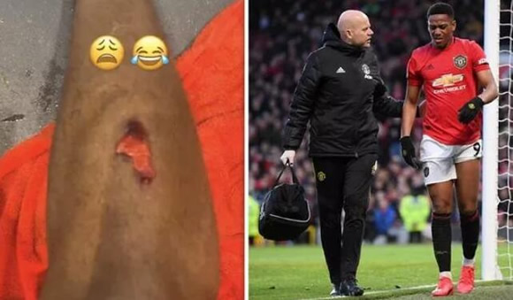 Man Utd star Anthony Martial shares gruesome snaps of bloody injury