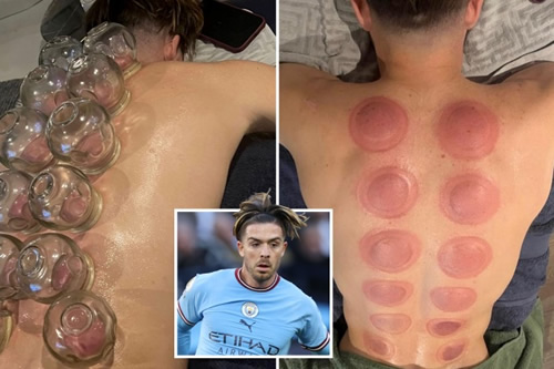 England ace Jack Grealish shares pictures of bizarre ‘hot cupping’ treatment