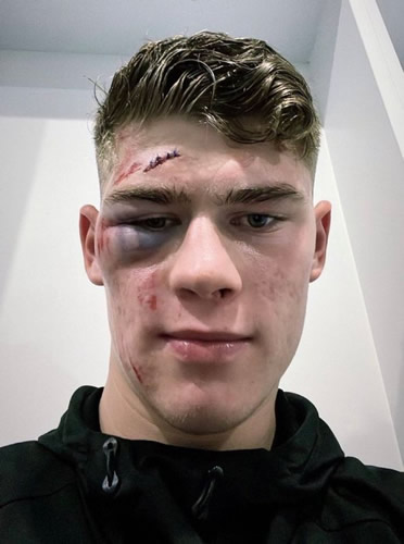 Millwall star left with black eye and horror